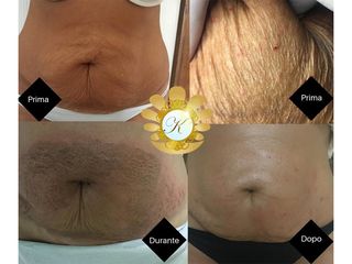 Smagliature - Clinica Villa Venus