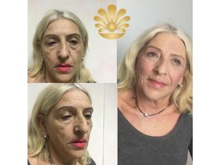 Lifting viso - Clinica Villa Venus