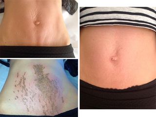 Smagliature - Clinica Villa Venus