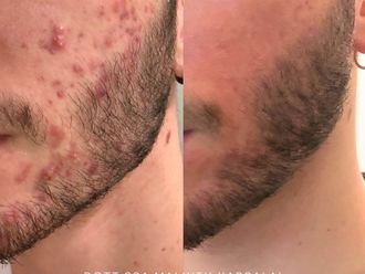 Acne prima e dopo - 870761