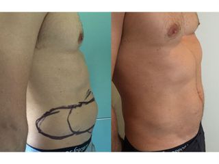 Pre post liposuzione