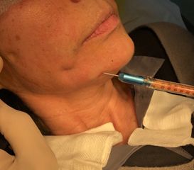 Lipofilling per rughe della marionetta