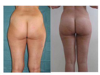 Liposuzione prima e dopo