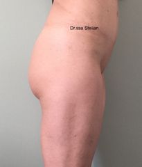 Acido ialuronico glutei