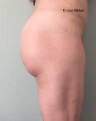 Acido ialuronico glutei