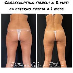 Criolipolisi con Coolsculptin - Dott.ssa Gabriela Stelian