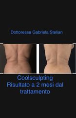 Coolsculpting pliche dorsali - Dott.ssa Gabriela Stelian