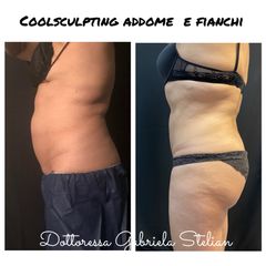 Riduzione non chirurgica del grasso addominale e fianchi