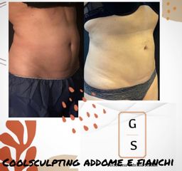 Coolsculpting - Dott.ssa Gabriela Stelian