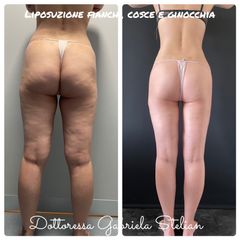 Liposuzione - Dott.ssa Gabriela Stelian