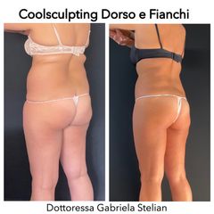 Riduzione non chirurgica degli accumuli adiposi con la Criolipolisi Coolsculpting Elite