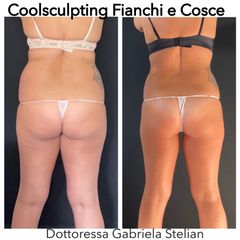 Riduzione non chirurgia degli accumuli adiposi con l'aiuto della Criolipolisi Coolsculpting Elite