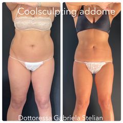 Riduzione non chirurgica degli accumuli adiposi resistenti alla dieta e sport con CoolsculptingElite