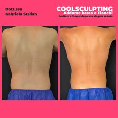 Criolipolisi - Dott.ssa Gabriela Stelian