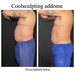 Criolipolisi - Dott.ssa Gabriela Stelian