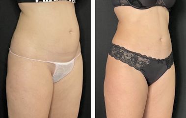 Coolsculpting Riduzione non chirurgica del grasso - Dott.ssa Gabriela Stelian