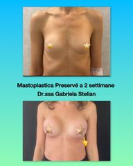Dott.ssa Gabriela Stelian_Mastoplastica additiva_Tecnica Preservè