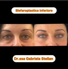 Dott.ssa Gabriela Stelian Blefaroplastica inferiore