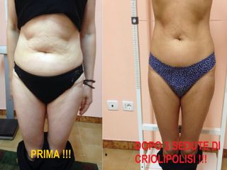 Criolipolisi prima e dopo