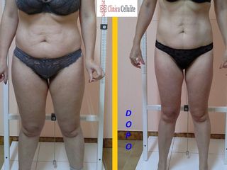 Liposuzione prima e dopo