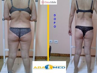 Liposcultura prima e dopo