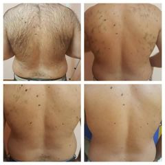 Depilazione Laser - ABAMED - Medicina Estetica & Bioingegneria dello Sport