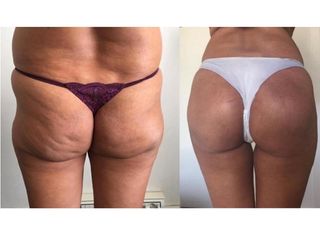 Glutei prima e dopo