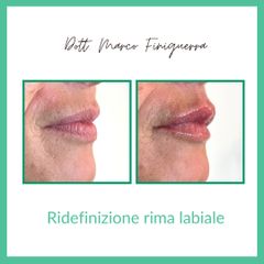 Filler labbra  - StudioMed Centro Medicina Estetica Asti