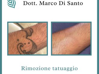 Rimozione tatuaggi - 858301