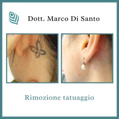 Rimozione tatuaggi - StudioMed Centro Medicina Estetica Asti