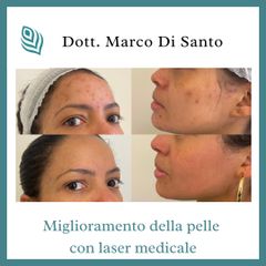 Cicatrici acne - StudioMed Centro Medicina Estetica Asti