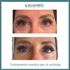 Eliminare occhiaie - StudioMed Centro Medicina Estetica