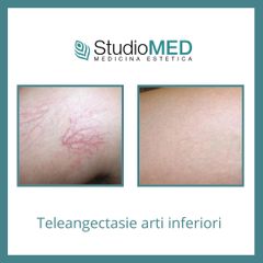 Rimozione tattoo - StudioMed Centro Medicina Estetica