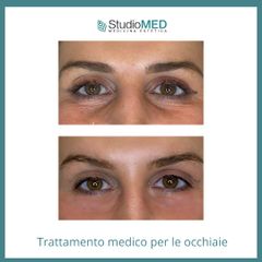 Eliminare occhiaie - StudioMed Centro Medicina Estetica