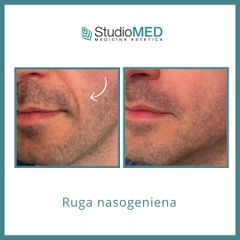 Filler - - StudioMed Centro Medicina Estetica