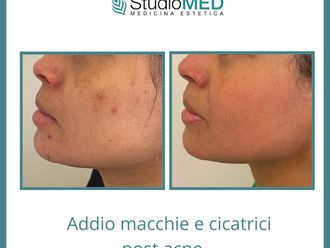 Acne prima e dopo - 868432