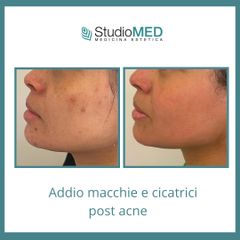 Acne - StudioMed Centro Medicina Estetica