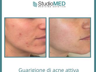 Acne prima e dopo - 868433