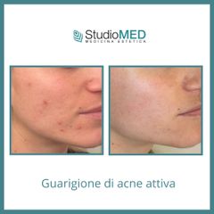 Acne - StudioMed Centro Medicina Estetica