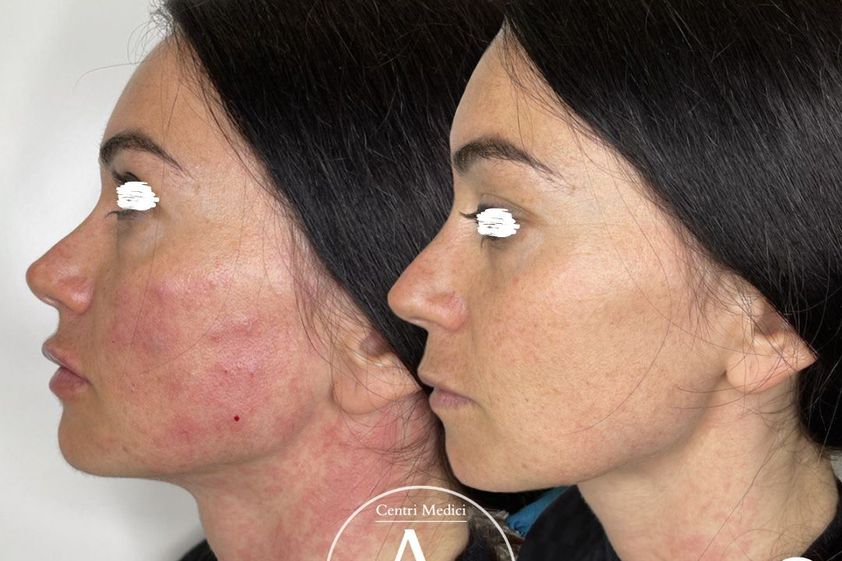 Psoriasi prima e dopo - 818933