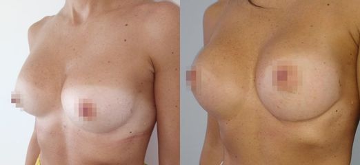 Mastoplastica additiva - Dr. Sergio Walter Curreri