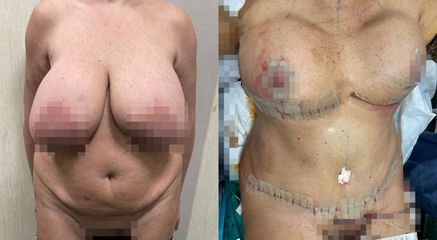 Liposcultura - Dr. Sergio Walter Curreri