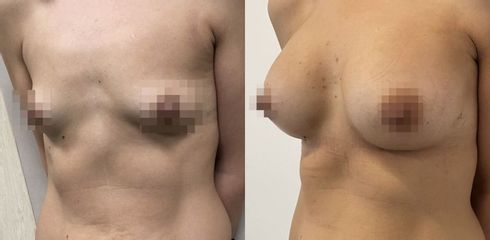 Mastoplastica additiva - Dr. Sergio Walter Curreri