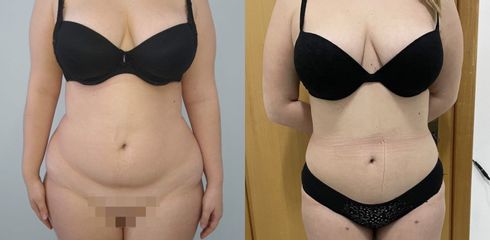 Liposuzione - Dr. Sergio Walter Curreri