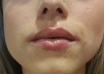 Filler labbra - Centro medico estetico dalle ceneri della fenice di Dott.ssa Marceddu