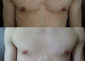 Acido ialuronico - Centro medico estetico dalle ceneri della fenice di Dott.ssa Marceddu