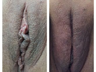 Vaginoplastica prima e dopo - 752815