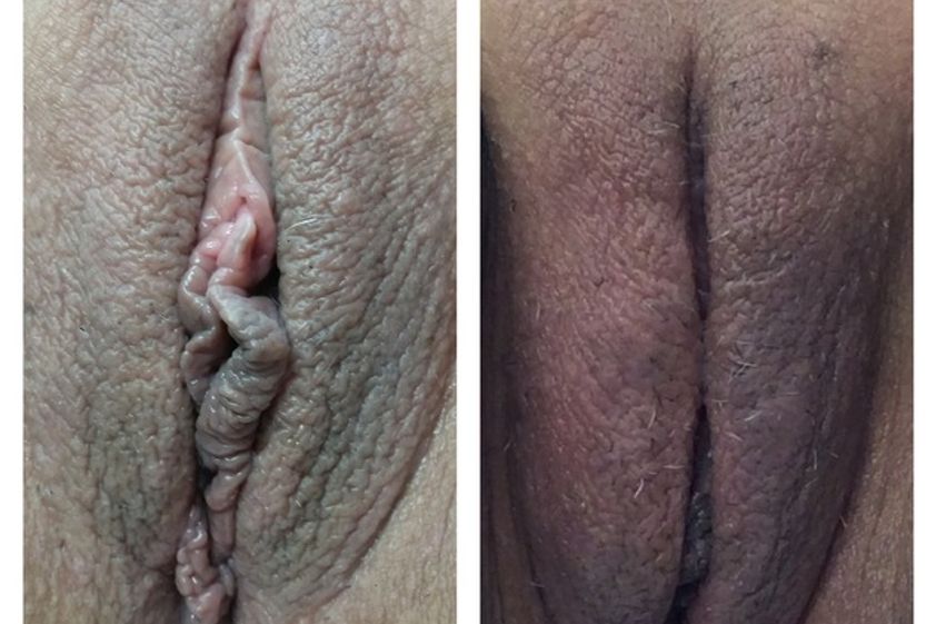 Vaginoplastica prima e dopo - 752815