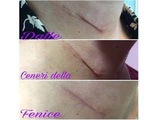 Cicatrici - Centro medico estetico dalle ceneri della fenice di Dott.ssa Marceddu