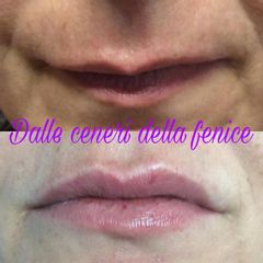 Filler labbra - Centro medico estetico dalle ceneri della fenice di Dott.ssa Marceddu